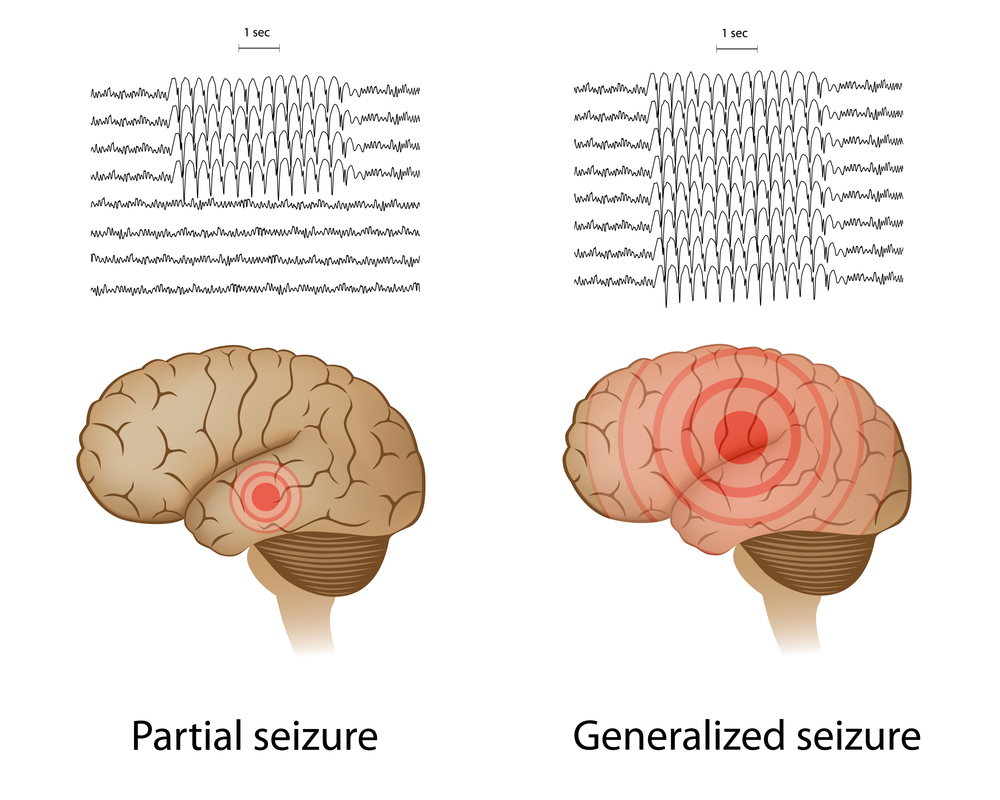 brainwave patterns during elileptic seizures